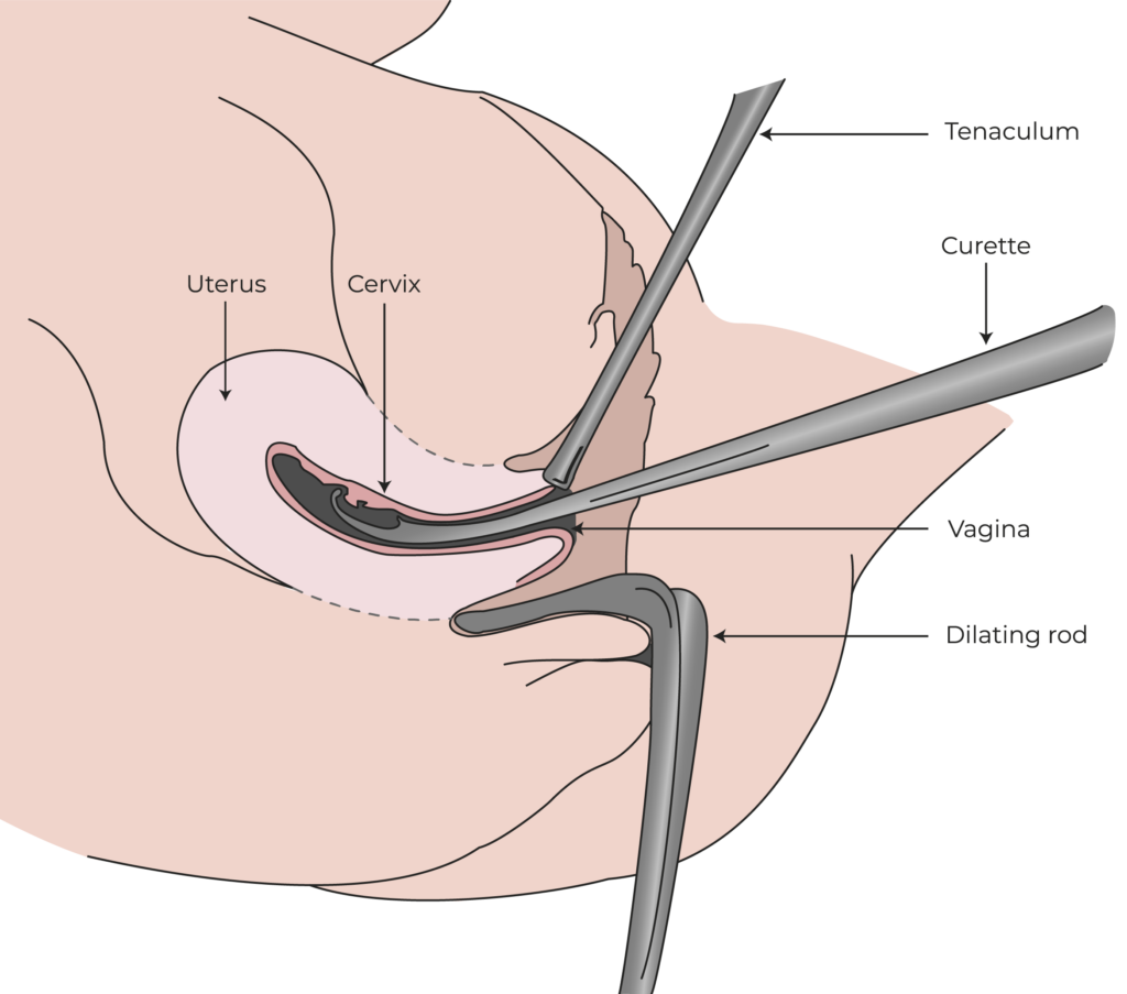 Dilation and curettage illustration