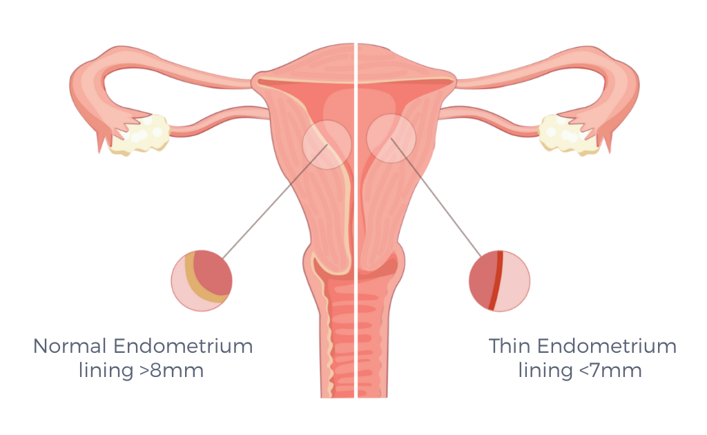 THIN ENDOMETRIUM ILLUSTRATION